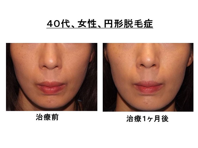 女性　脱毛症　名医""